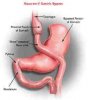 roux-en-y-gastric-bypass.jpg