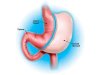 gastric-sleeve.jpg