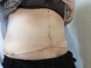 Sue Tummy - 2 Weeks On Pic 2.JPG