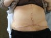 Sue Tummy - 2 Weeks On.JPG