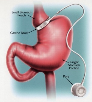 10077038-gastric-band.jpg