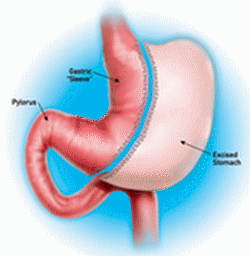 Gastric%20Sleeve.gif