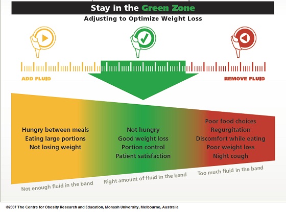 lapband-green-zone.jpg