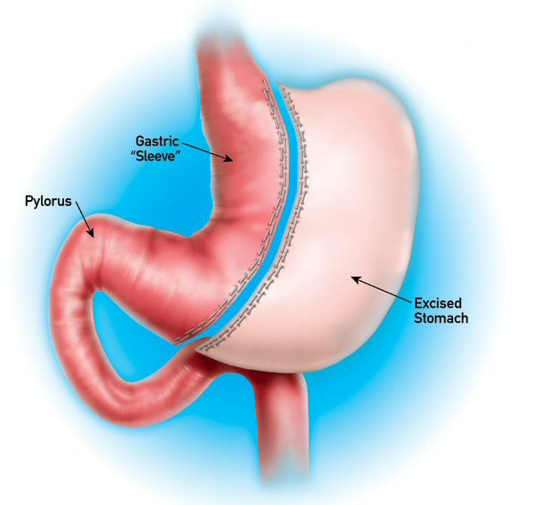 sharma-obesity-verticalsleevegastrectomy.jpeg